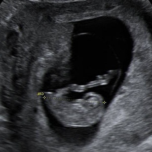 Hasil ultrasound janin minggu ke-9